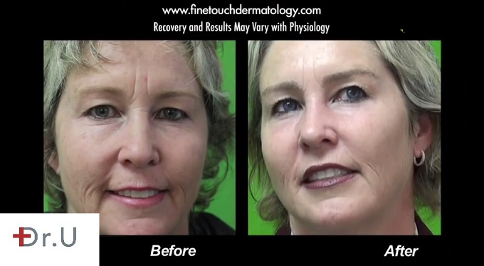 This patient's eyebrow transplant procedure shows that shaping eyebrows does not have to be a daily or even weekly chore. She approached Dr. U for an eyebrow transplant inspired by Brooke Shields, whom she has always admired, and was very pleased with the result.