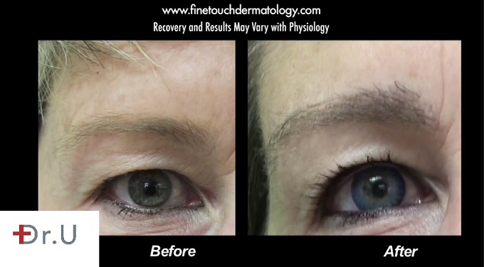 Improved Definition, Shape & Density| Nape Hair Grafts Improved Definition, Shape & Density| Nape Hair Grafts