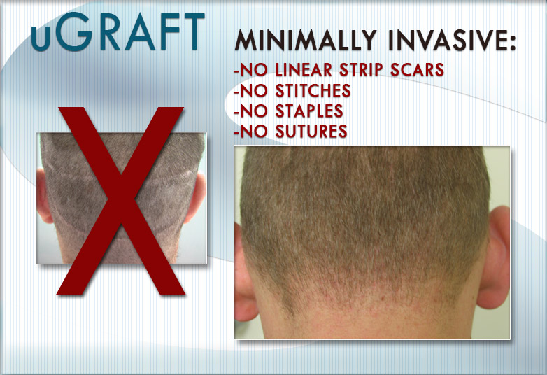 Buzz cut after UGraft follicular unit extraction vs strip hair surgery