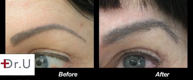 A close up view of patient's eyebrows before and after her UGraft FUE hair transplant for eyebrow restoration