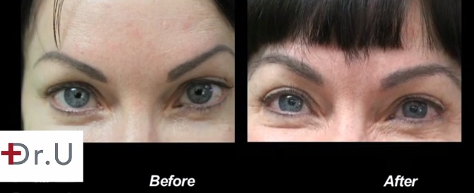 eyebrow hair transplant after surgery care