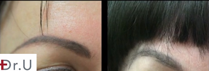 Nape Hair Grafts| Eyebrow Reconstruction 