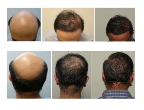 Dr U Hair Restoration Testimonials by S.K - Before and after photos