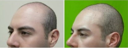 Best Treatment for male Pattern Baldness