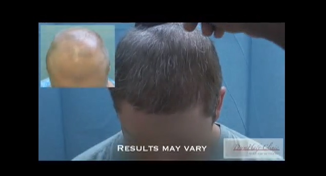 FUE-hair-restoration-9930