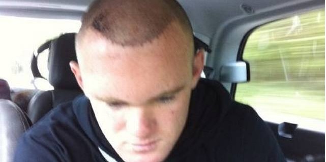 Wayne Rooney Starts Hair Transplant Recovery
