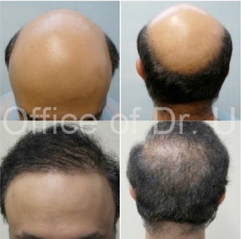 Severe Baldness Reversal With 8,000 Grafts by UGraft BHT Before and After First BHT Surgery 8000 grafts | Front and Back View of Patient's Results