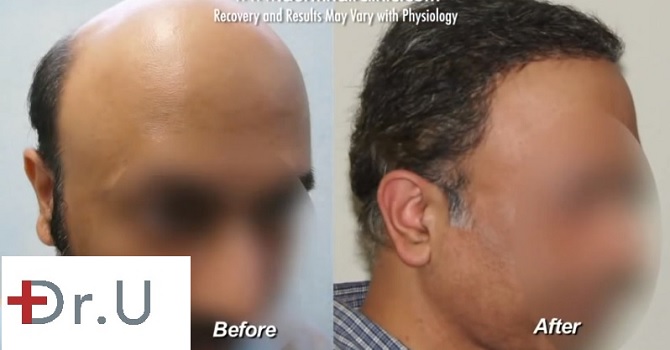 Three Quarters View|Body Hair Transplant Patient before and after 12000 grafts with the UGraft FUE