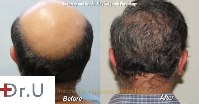 Body Hair Transplant - BHT, Patient before and after 12000 grafts with the UGraft FUE Reversing Crown Baldness| Body Hair Transplant - BHT, Patient before and after 12000 grafts with the UGraft FUE