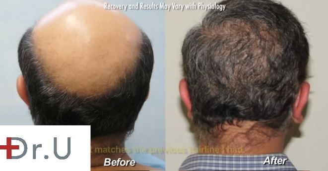 Reversing Crown Baldness| Body Hair Transplant - BHT, Patient before and after 12000 grafts with the UGraft FUE