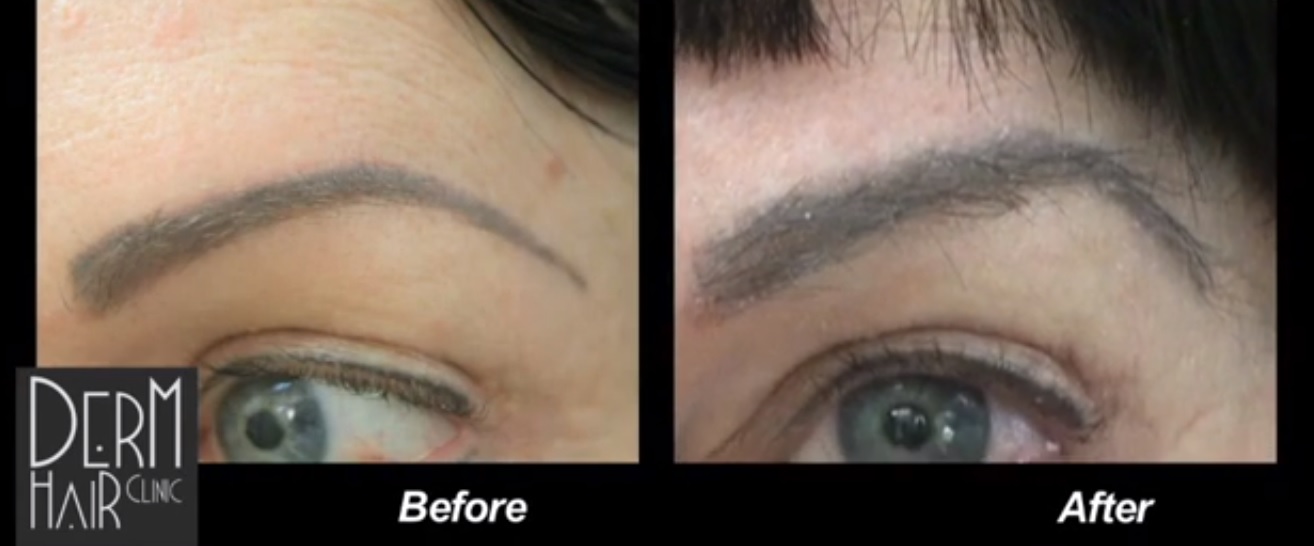 eyebrow hair transplant arches. eyebrow hair transplant procedures