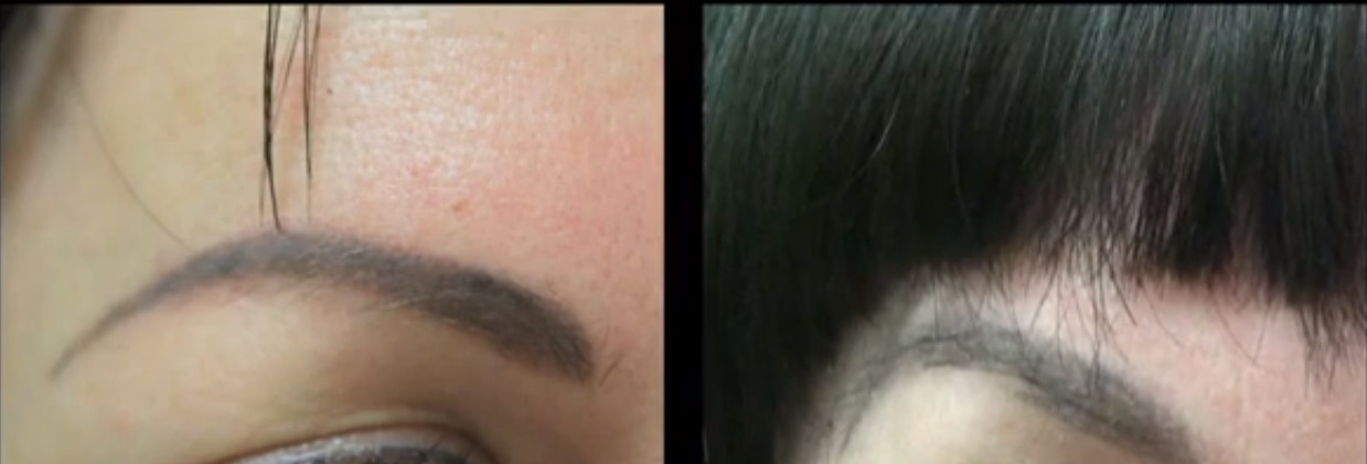 How Does Eyebrow Restoration Work - Eyebrow Restoration Conceals Tattoo Ink