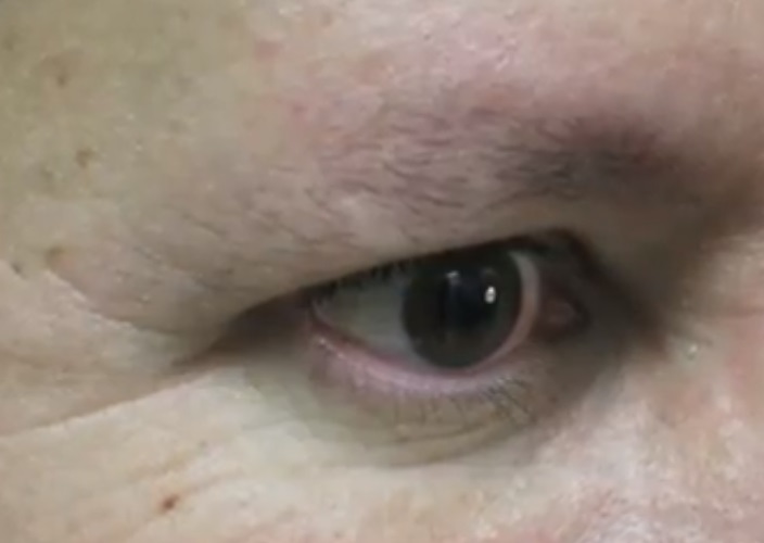 Male Patient Before His Eyebrow Hair Transplant