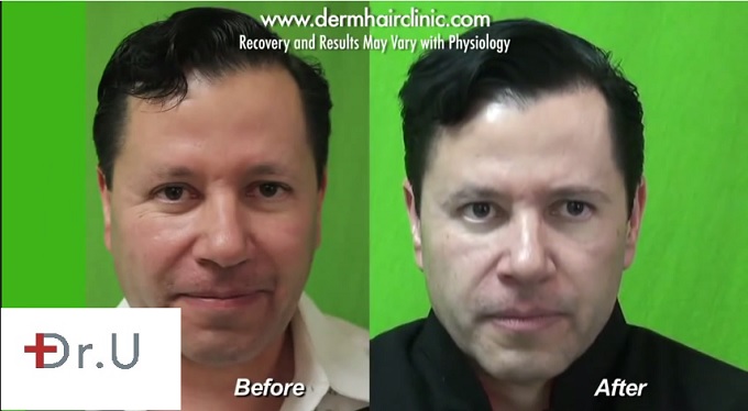 Patient's Appearance With New Eyebrows| Leg Hair Grafts