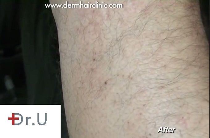 Leg donor area| Healing after leg hair UGraft FUE for eyebrow transplantation surgery - eyebrow restoration results