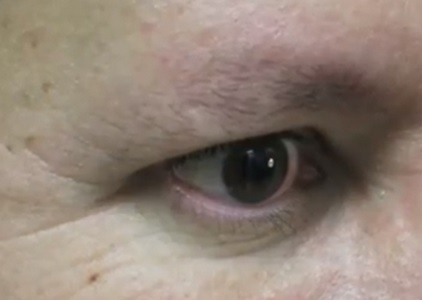 Male Patient With Sparse Eyebrows| Before Leg hair Eyebrow Restoration Results