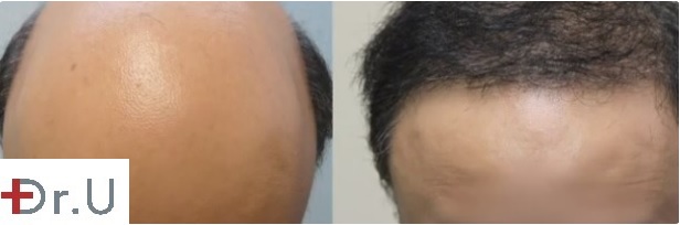 Severe Baldness Reversal With 8000 Grafts by UGraft BHT - results 