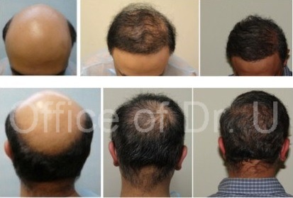 Patient After First and Second BHT Operations| 12000 Grafts of Body and Head Hair