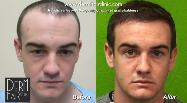 FUE hair restoration for Hairline lowering