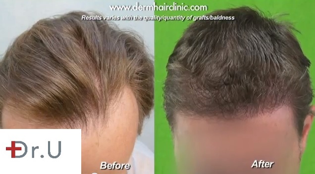 Frontal Scalp & Hairline|Before & After FUE -3000 Grafts