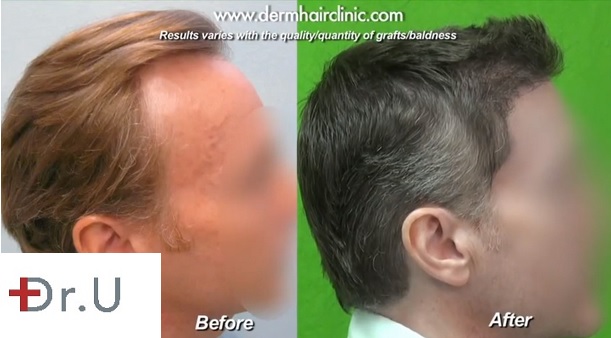 Profile View| FUE Hairline & Temple Restoration - 3000 Grafts