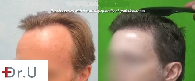 UGraft Method is an evolution in Follicular Unit Extraction