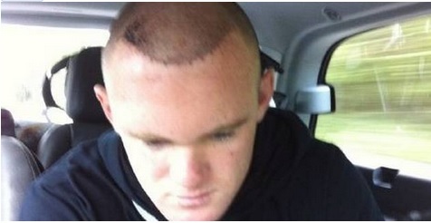 Wayne Rooney Tweets Hair Transplant Photo