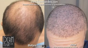 Scalp Micropigmentation Versus An Actual Hair Surgery