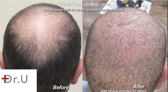 Baldness in Crown| New Coverage With Body Hair Grafts