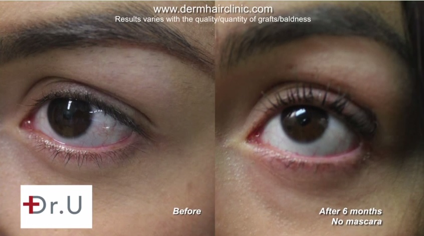 Eyelash Transplant Results With Leg Hair Grafts- No Mascara