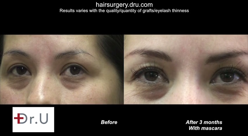 Longer Eyelashes| Eyelash Transplant Surgery Results - With Mascara