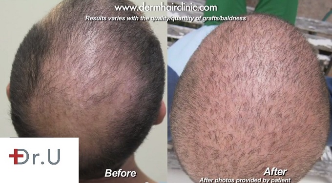 Results of BHT For Global Coverage & Concealing A Strip Scar - 13000 uGrafts