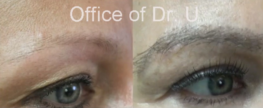 before and after eyebrow hair transplant using 400 grafts by UGraft