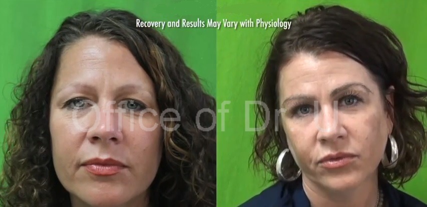 Eyebrow Transplant Patient| Satisfied With Her Results