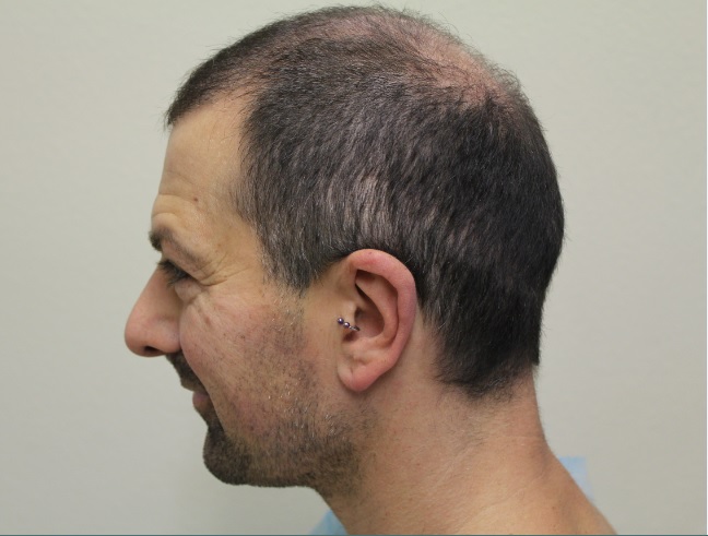 Patient is forced to grow hair on the back and sides of the head long to hide the strip surgery scar 