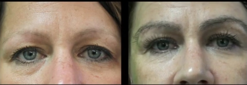 Eyebrow Transplants Vs Typical Transplants 