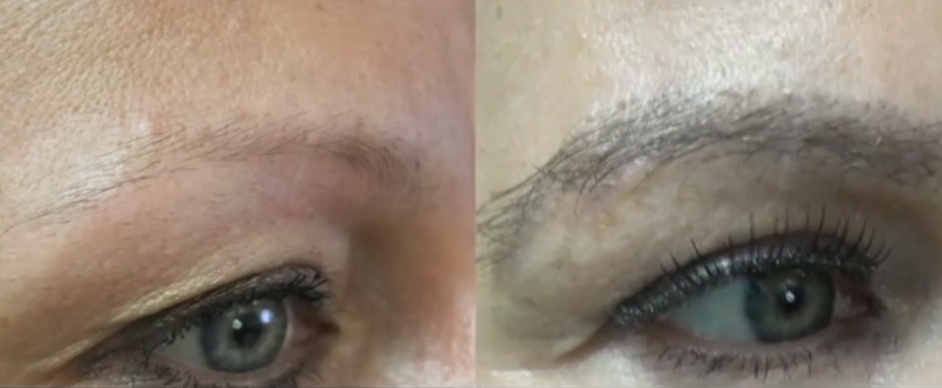 Fuller, Thicker Eyebrows Through Transplant Surgery