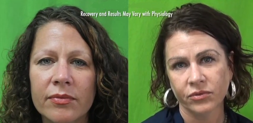 Eyebrow Reconstruction|FUE Hair Transplant