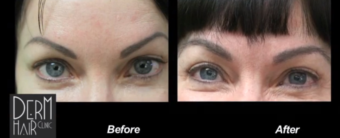 patient's eyebrow transplant results