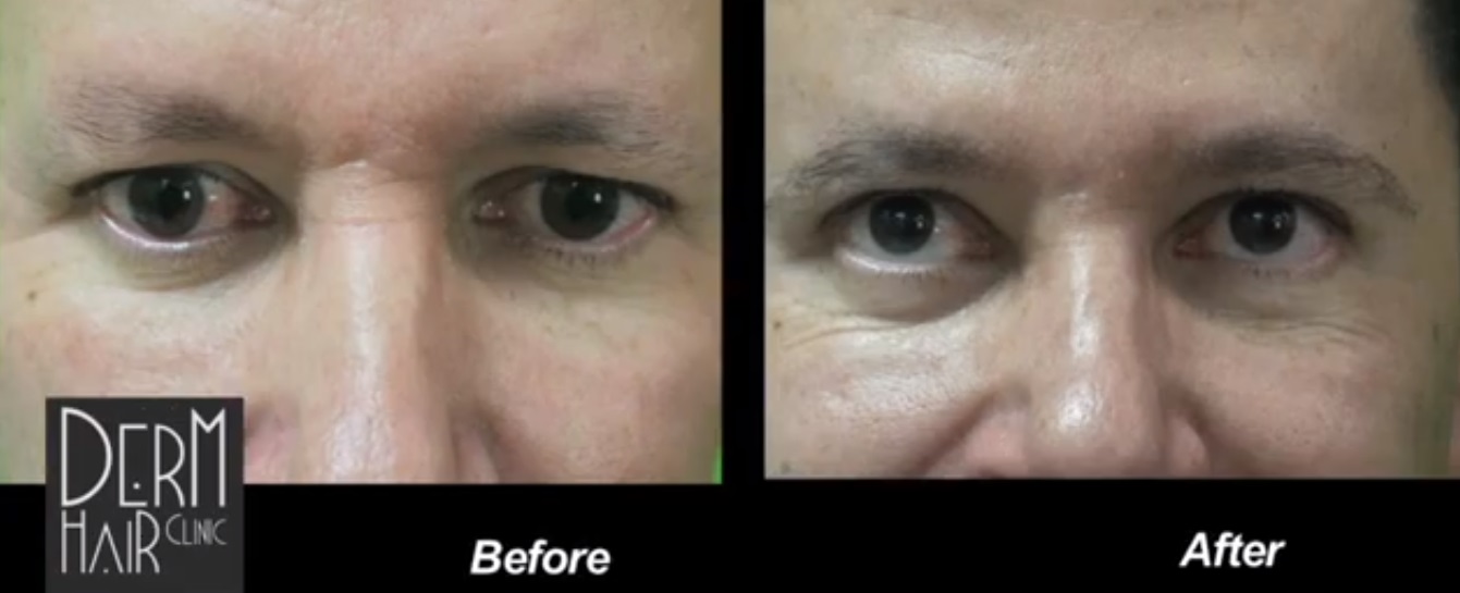 Evidence of leg hair use in eybrow hair transplant eyebrow hair transplant using leg hair, the evidence