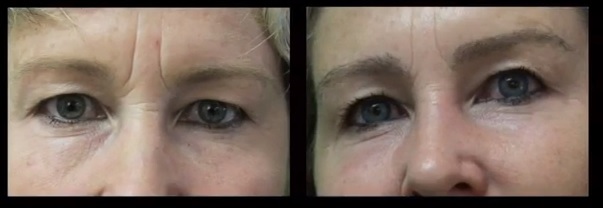 Eyebrow Transplant for New Shape and Better Density