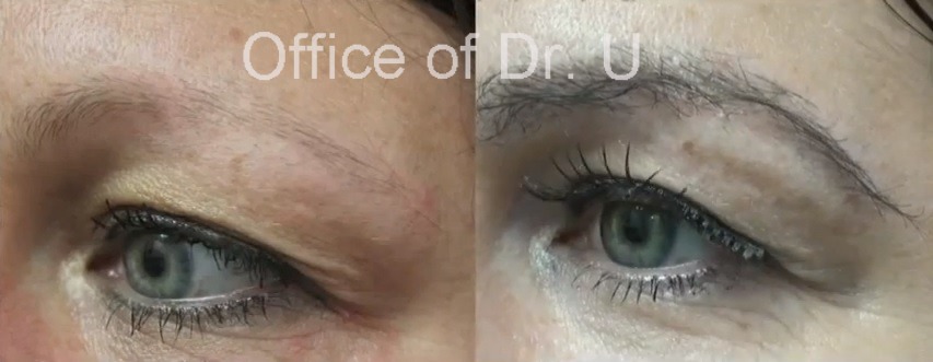 Close Up View of eyebrow hair transplant Results| Improved Definition