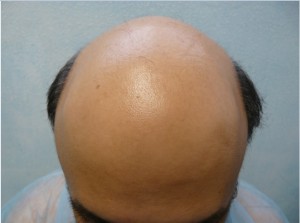 Severe Hair Loss - Follicles to treat hair loss