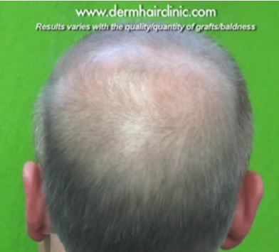 Hair loss info|Male Pattern Baldness