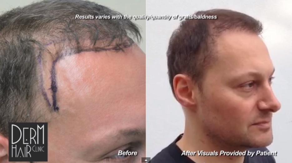FUE Hair Restoration With 1500 Grafts