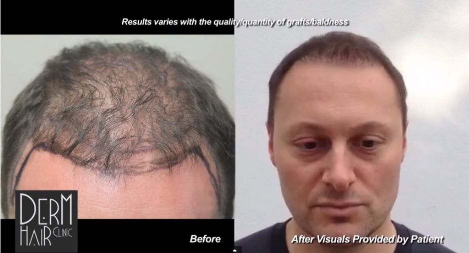 1500 FUE Grafts For Excellent Coverage and Hairline Results