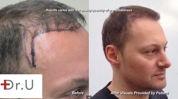 1500 Nape derived grafts for a subtle hairline refinement 1500 Nape derived grafts for a subtle hairline refinement