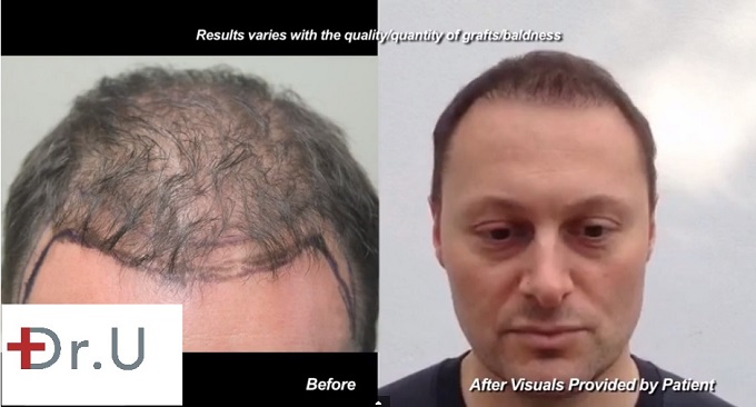 Hairline Restoration|1500 FUE Grafts