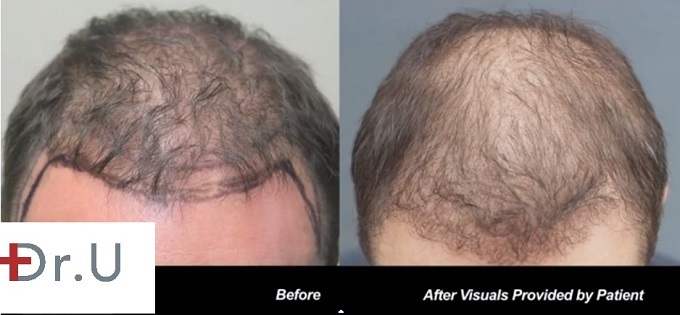 View of Frontal Scalp|FUE procedure 1500 grafts