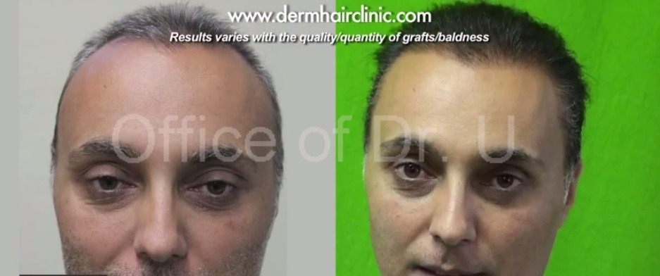 New Hairline and Temples| Body Hair Transplant Results